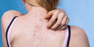 Acne sulla schiena: cure e consigli per eliminare i brufoli sulla schiena